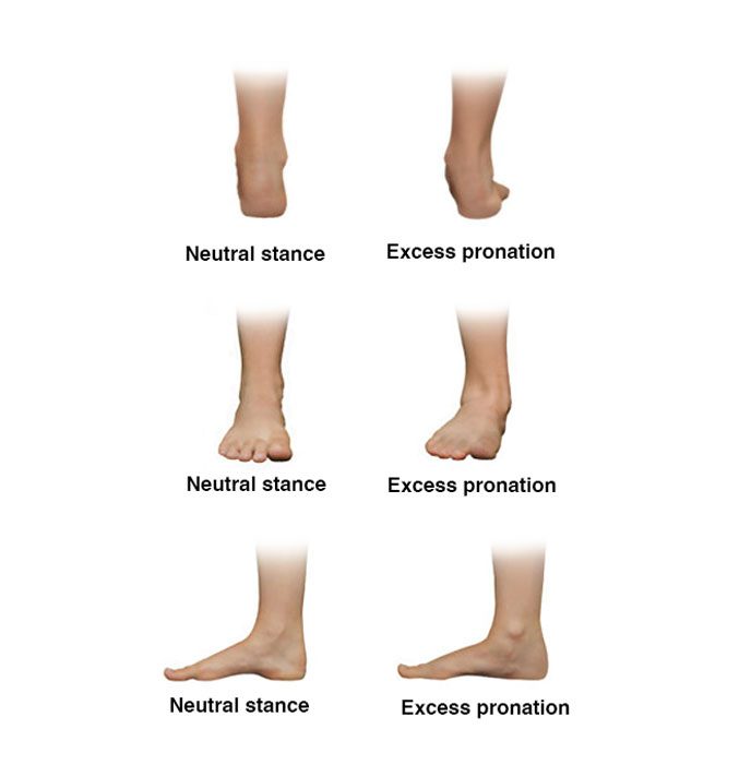 flat feet fallen arches and over-pronation
