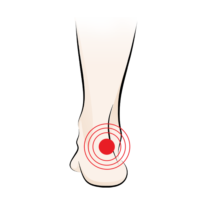 Illustration of a foot with a red target symbol on the heel, indicating pain or injury in the heel area.