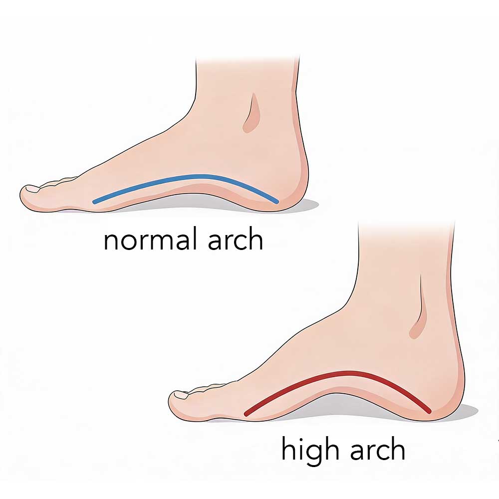 Illustration comparing a normal foot arch and a high arch, with colored lines highlighting the arch differences.