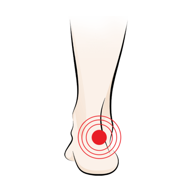 Illustration of a foot with a red target marking pain or discomfort on the outer side of the ankle.