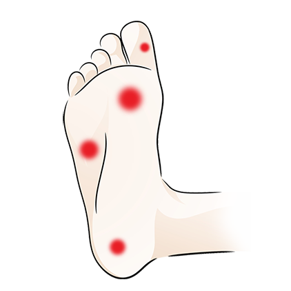 Illustration of a foot with four red spots indicating pain or discomfort on the heel, ball, big toe, and side of the foot.