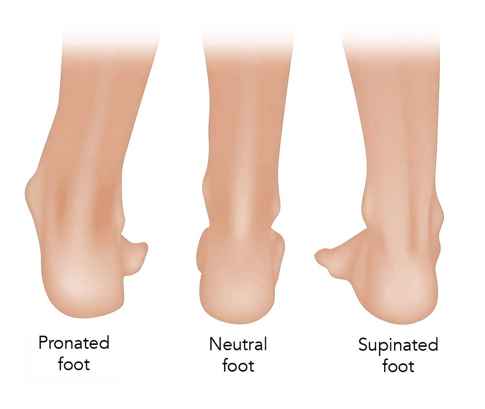 Three illustrations compare foot positions: pronated foot tilts inward, neutral foot is straight, and supinated foot tilts outward. Labels identify each foot position.