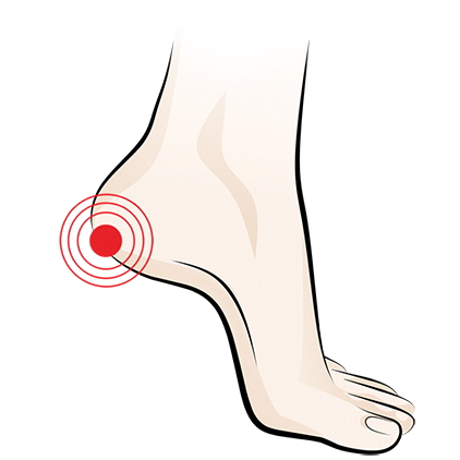 Plantar Fasciitis pain in the heel