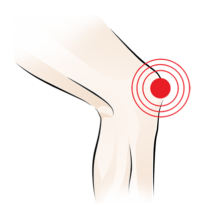 Illustration of a knee with a red target symbol indicating pain or injury at the joint.