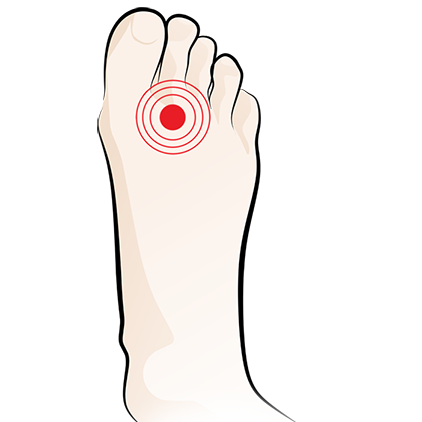 Illustration of a left foot with a red target symbol highlighting pain or injury on the second toe.