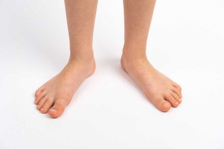 Child with flat feet and over-pronation