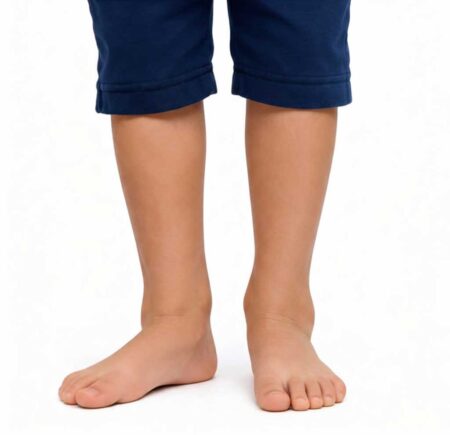 A child with flat feet and fallen arches