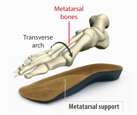 Meta Bone Support for treament of Metatarsalgia